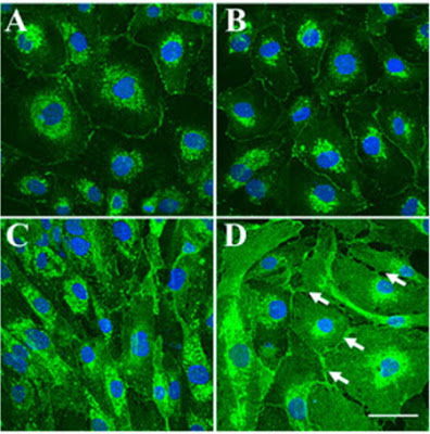 Effect of HG (high glucose) and pro-inflammatory cytokines on connexin43 expression in HRMECs. Immunohistochemical data showing connexin43 expression in (A) normal medium; (B) HG (25 mM); (C) pro-inflammatory cytokines (IL-1β and TNF-α 10 ng/mL each); and (D) a combination of HG and pro-inflammatory cytokines inducing a change in cell morphology with signs of cell swelling, possibly owing to hemichannel opening (indicated by white arrows). https://doi.org/10.1080/02713683.2017.1410180