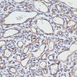 CD34 staining of paraffin-embedded human capillary hemangioma.