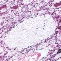 TH staining of human mid-brain. Note cytoplasmic staining of catecholaminergic cells and their processes. Paraffin section (Peroxidase substrate: nickel DAB, Counterstain: eosin).