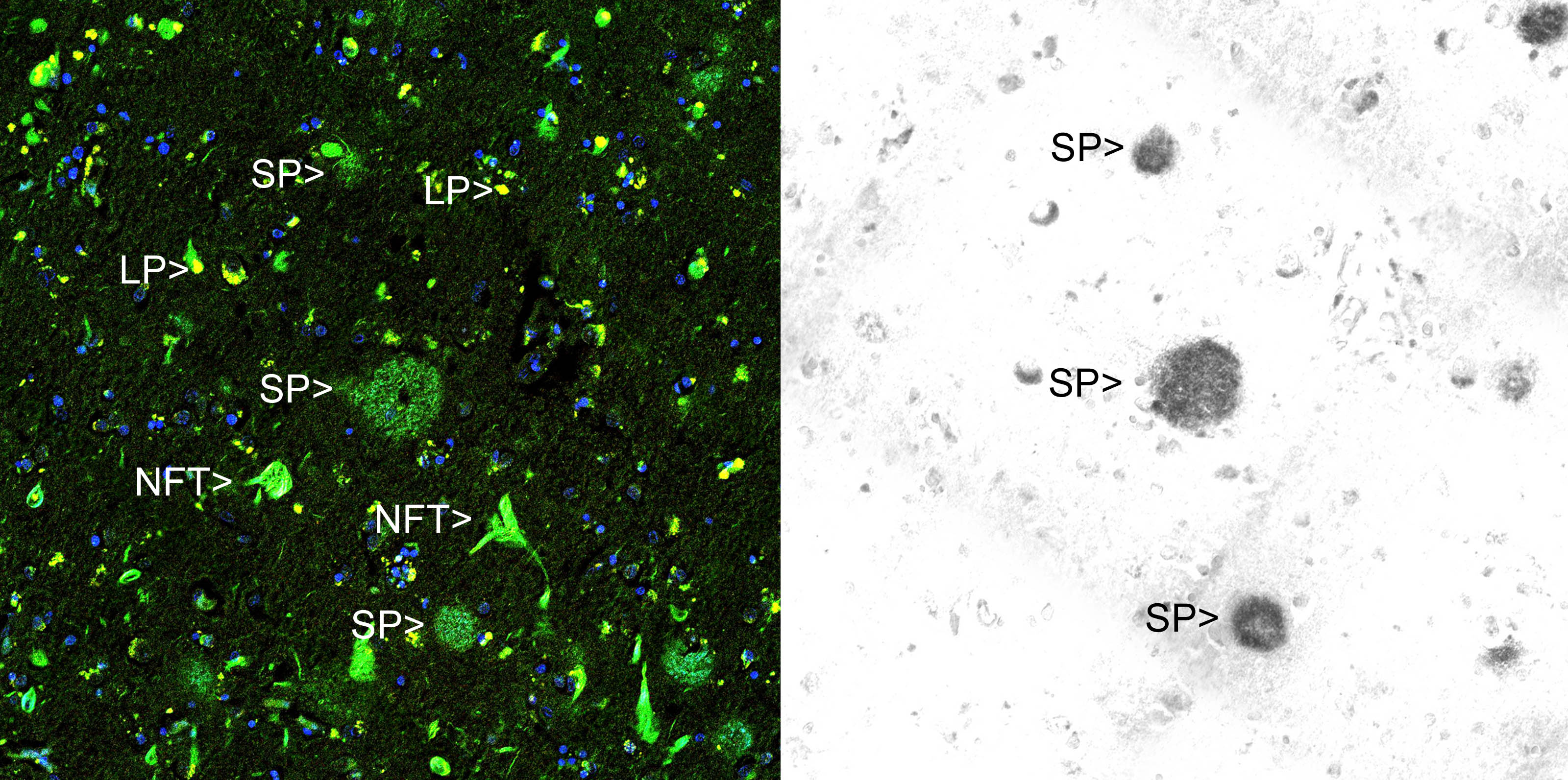 Immunohistochemical analysis of paraffin-embedded Alzheimer’s hippocampus using Thioflavin S (left panel) and MO22141 using the HRP-DAB staining technique.
