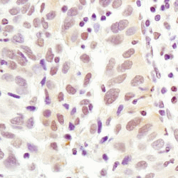 AP-2α atining of paraffin-embedded human lung carcinoma